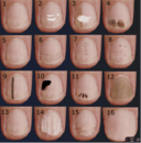 Een gewone nagel (fig. 1) en de mogelijke aandoeningen aan je nagels.