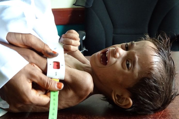 Ahmed Abdo Salem, een tweejarig ontheemd Jemenitisch jongetje, is één van de vele kinderen die lijdt aan zware ondervoeding door de burgeroorlog in Jemen.