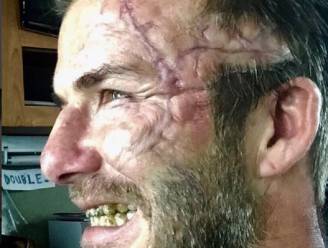 David Beckham verrast volgers op Instagram met foto van enorm litteken