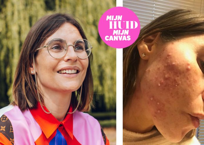 Marie voerde jarenlang een strijd tegen acne.