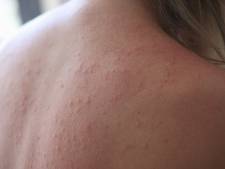 ‘Vlekken die opduiken en snel weer verdwijnen, duiden op netelroos’: een dermatoloog geeft advies