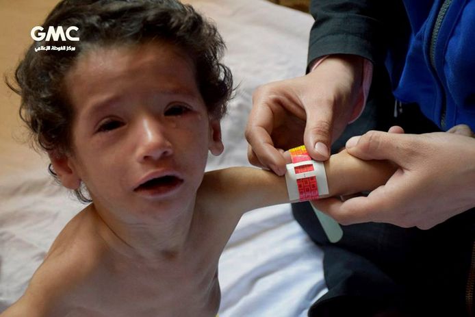 Een arts meet de voorarm van een ondervoed kind in Ghouta. Volgens Unicef is de ondervoeding van kinderen het ergst sinds het begin van de oorlog in Syrië, nu bijna zeven jaar geleden.