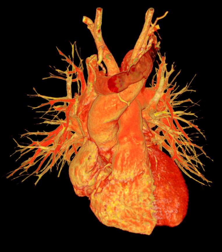 Een 3D-angiogram van een mensenhart. De CT-scan bevat delen van de bloedvaten (links en rechts) en delen van de grootste aderen. Beeld Science Photo Library