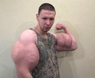 Bodybuilder laat met olie gevulde megabiceps weghalen: ‘Raar hoor, die dunne armen’