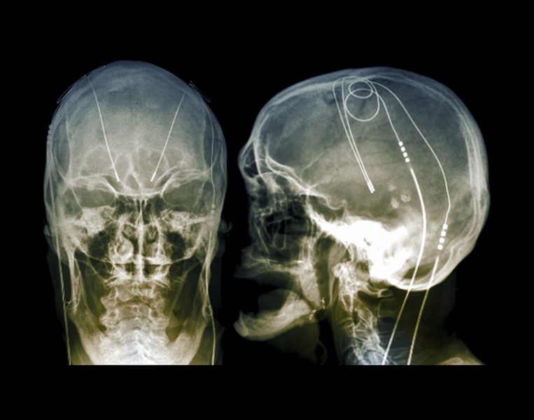 Röntgenfoto’s van een parkinsonpatiënt met elektroden in de hersenen. Beeld ANP / Science Photo Library