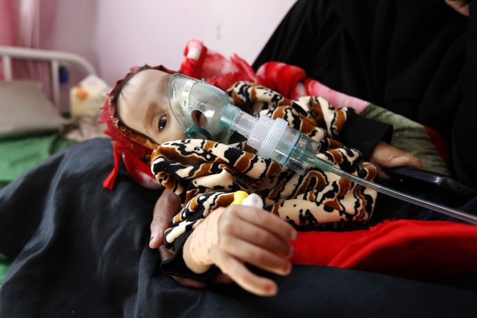 Een ondervoed Jemenitisch kind wordt behandeld in het ziekenhuis van de hoofdstad Sanaa.