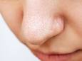 Dermatoloog geeft concrete tips voor minder zichtbare poriën in je gezicht: “Je kan mee-eters zo makkelijker uitduwen”