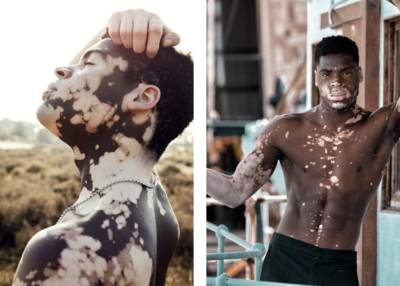Love Islander Gideon ziet zijn huidziekte als troef. “Het leven is pas begonnen nadat ik vitiligo heb gekregen”