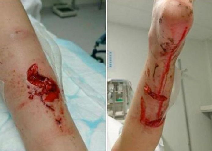 Het meisje moest aan haar benen geopereerd worden, over enkele weken moet ze opnieuw onder het mes.