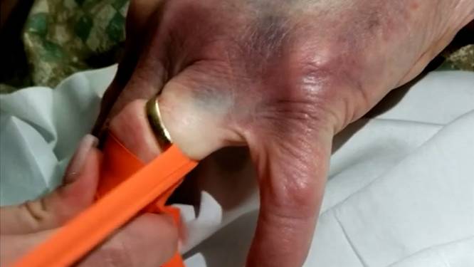 Verpleegster deelt geniale truc om ring van dikke vinger te krijgen
