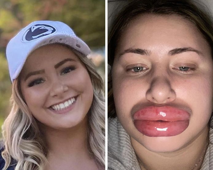 Il s'est avéré que Kailee Jones était allergique au produit injecté dans ses lèvres.
